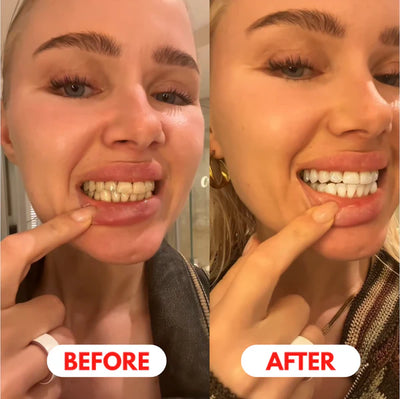 Teeth Brightening Gel Pen